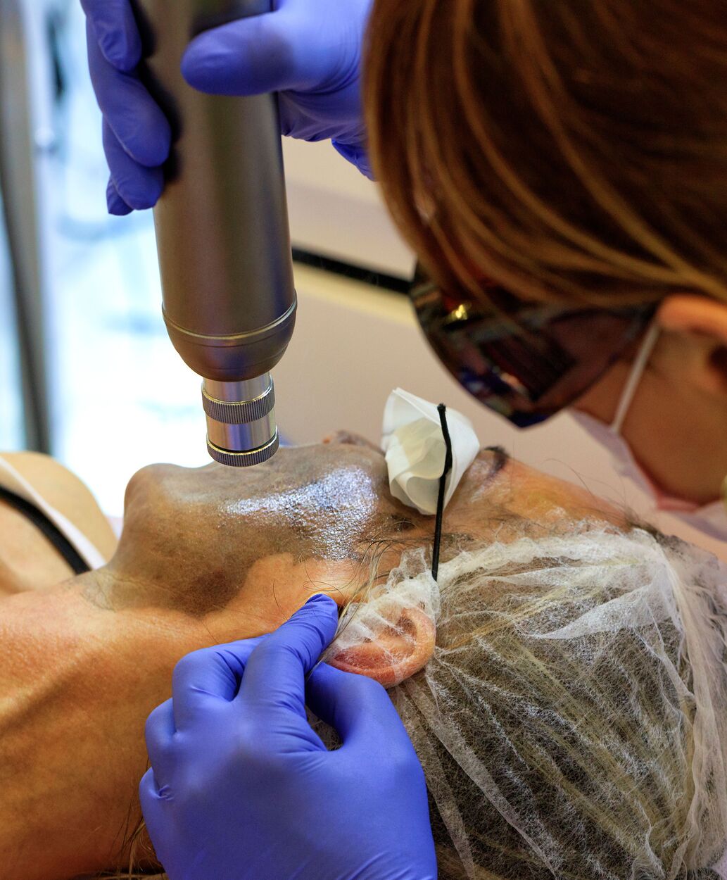 Laser Skin Treatment : Vascular Removal