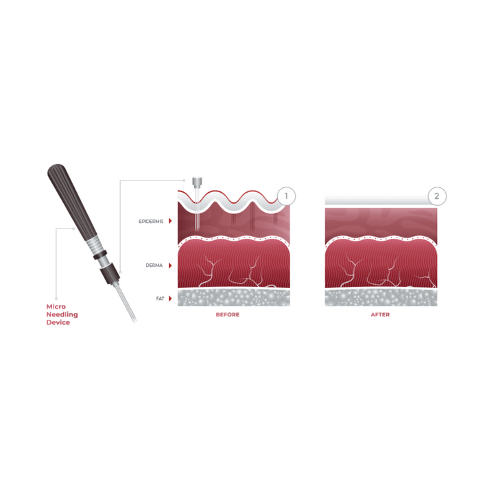 Microneedling