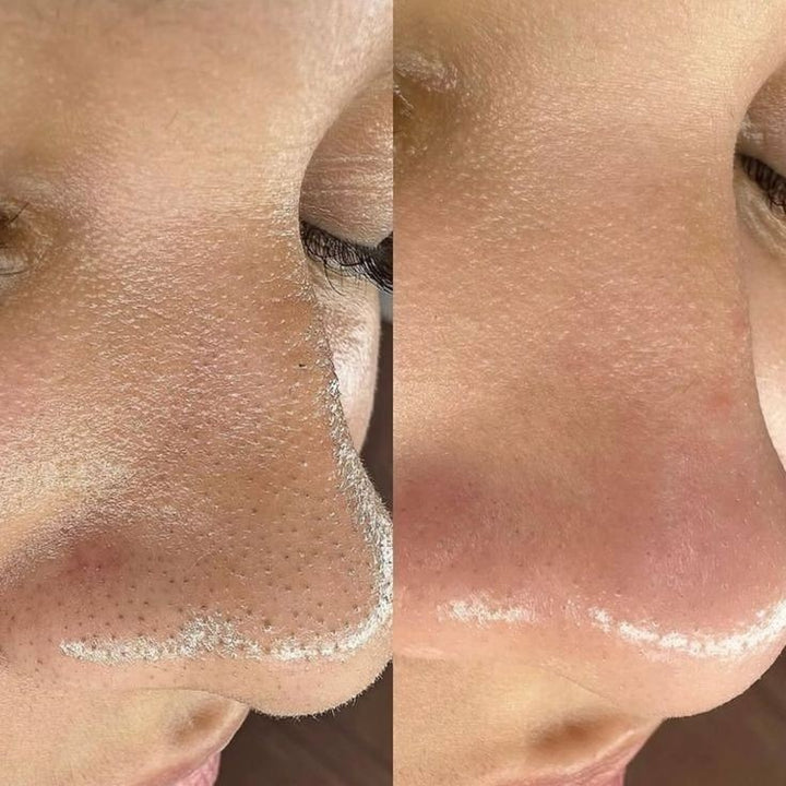 Microneedling