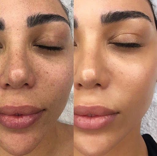 Microneedling