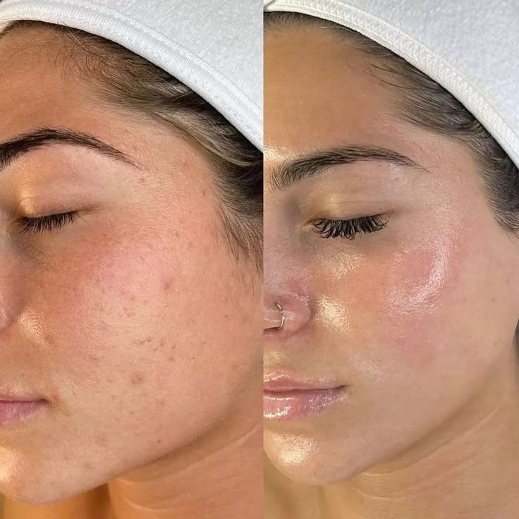 Microneedling