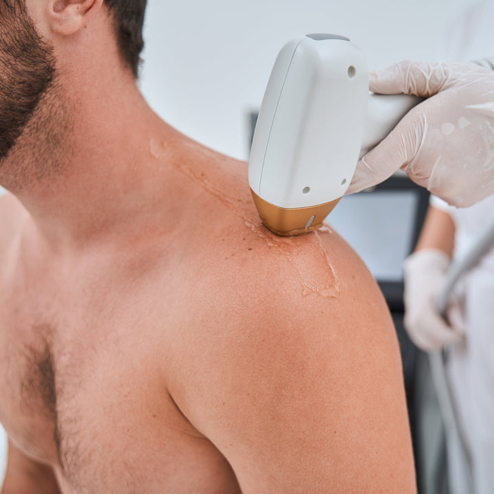 Laser Hair Removal : Upper Body
