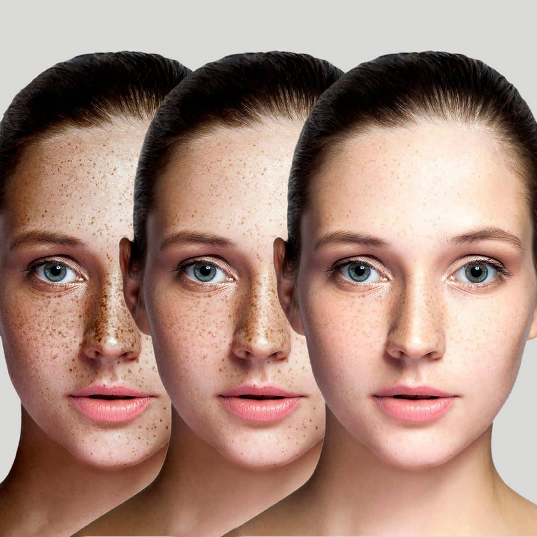 Microneedling